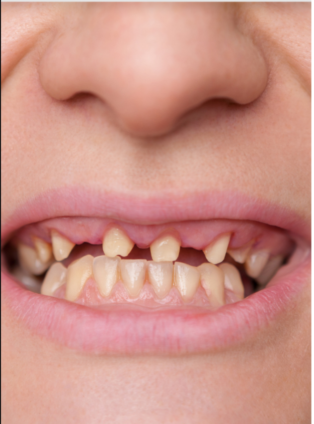 Dental crowns — after